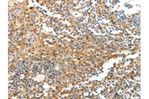 The image on the left is immunohistochemistry of paraffin-embedded Human tonsil tissue using ABIN7129267(DTX3 Antibody) at dilution 1/20, on the right is treated with fusion protein. (Deltex Homolog 3 抗体)