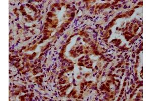 IHC image of ABIN7174204 diluted at 1:600 and staining in paraffin-embedded human lung cancer performed on a Leica BondTM system.