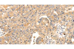 Immunohistochemistry of paraffin-embedded Human breast cancer tissue using S100A12 Polyclonal Antibody at dilution 1:45 (S100A12 抗体)