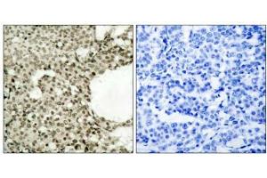 Immunohistochemical analysis of paraffin-embedded human breast carcinoma tissue using STAT1 (phospho- Ser727) antibody (E011163). (STAT1 抗体  (pSer727))