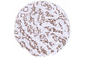 Strong INSM1 immunostaining in a low grade neuroendocrine tumor of the appendix (Recombinant INSM1 抗体  (AA 81-125))