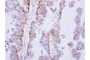 IHC-P Image Immunohistochemical analysis of paraffin-embedded OVCA xenograft, using SHP1, antibody at 1:100 dilution.