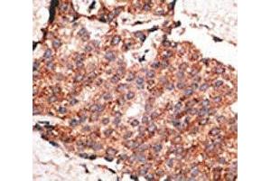 IHC analysis of FFPE human breast carcinoma tissue stained with the BMP1 antibody (BMP1 抗体  (AA 957-986))