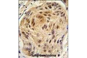 Formalin-fixed and paraffin-embedded human lung carcinoma tissue reacted with LSM1 antibody (C-term) (ABIN389386 and ABIN2839481) , which was peroxidase-conjugated to the secondary antibody, followed by DAB staining. (LSM1 抗体  (C-Term))