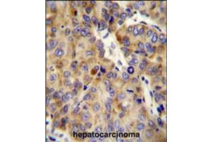 COL18A1 Antibody immunohistochemistry analysis in formalin fixed and paraffin embedded human hepatocarcinoma followed by peroxidase conjugation of the secondary antibody and DAB staining. (COL18A1 抗体  (AA 1311-1339))