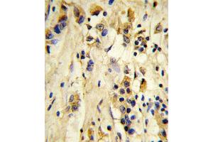 Formalin-fixed and paraffin-embedded human breast carcinoma reacted with EIF4E2 Antibody, which was peroxidase-conjugated to the secondary antibody, followed by DAB staining. (EIF4E2 抗体)