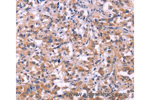 Immunohistochemistry of Human thyroid cancer using MMP14 Polyclonal Antibody at dilution of 1:40 (MMP14 抗体)