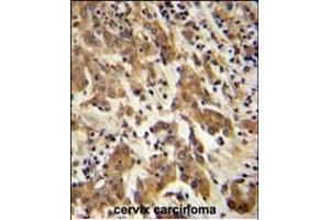 GK Antibody (C-term) (ABIN651665 and ABIN2840349) immunohistochemistry analysis in formalin fixed and paraffin embedded human cervix carcinoma followed by peroxidase conjugation of the secondary antibody and DAB staining. (GKAP1 抗体  (C-Term))