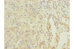 Immunohistochemistry of paraffin-embedded human liver cancer using ABIN7144623 at dilution of 1:100 (ARMCX2 抗体  (AA 161-460))