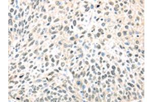 The image on the left is immunohistochemistry of paraffin-embedded Human lung cancer tissue using ABIN7128027(TCEB1 Antibody) at dilution 1/40, on the right is treated with fusion protein. (TCEB1 抗体)
