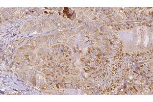 ABIN6267103 at 1/100 staining Human thyroid cancer tissue by IHC-P.