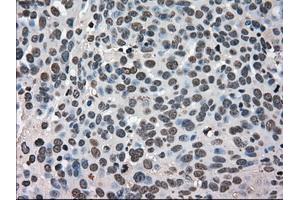 Immunohistochemical staining of paraffin-embedded Adenocarcinoma of breast tissue using antiHSPA9 mouse monoclonal antibody. (HSPA9 抗体)