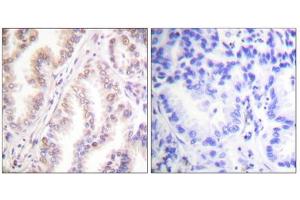 Immunohistochemistry analysis of paraffin-embedded human lung carcinoma tissue using PIAS1 antibody. (PIAS1 抗体  (N-Term))