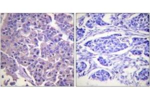 Immunohistochemistry analysis of paraffin-embedded human breast carcinoma tissue, using Caldesmon (Ab-789) Antibody. (Caldesmon 抗体  (AA 744-793))