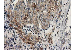 Immunohistochemical staining of paraffin-embedded Adenocarcinoma of Human breast tissue using anti-MAPRE2 mouse monoclonal antibody. (MAPRE2 抗体)