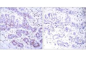 Immunohistochemistry analysis of paraffin-embedded human breast carcinoma tissue, using STAT4 (Ab-693) Antibody. (STAT4 抗体  (AA 660-709))