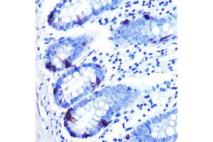 Immunohistochemistry of paraffin-embedded human colon carcinoma using Zinc-α2-glycoprotein (ZAG/) Rabbit mAb (ABIN7265556) at dilution of 1:100 (40x lens). (AZGP1 抗体)