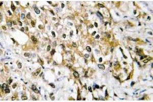 Immunohistochemistry (IHC) analyzes of c-Myc antibody in paraffin-embedded human liver carcinoma tissue. (c-MYC 抗体)