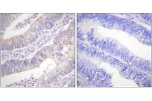 Immunohistochemistry analysis of paraffin-embedded human colon carcinoma tissue, using CFTR (Ab-737) Antibody. (CFTR 抗体  (AA 711-760))