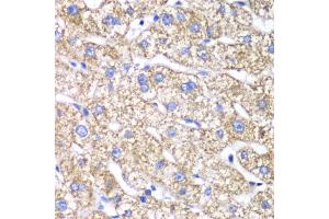 Immunohistochemistry of paraffin-embedded human liver damage using DLST antibody (ABIN6130277, ABIN6139665, ABIN6139667 and ABIN6217240) at dilution of 1:100 (40x lens). (DLST 抗体  (AA 1-290))