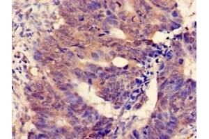 Immunohistochemistry of paraffin-embedded human colon cancer using ABIN7159726 at dilution of 1:100 (MGST2 抗体  (AA 27-57))