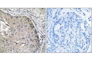 Immunohistochemistry analysis of paraffin-embedded human lung carcinoma tissue, using AOX1 Antibody. (AOX1 抗体  (AA 521-570))