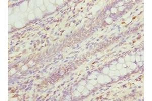 Immunohistochemistry of paraffin-embedded human colon cancer using ABIN7167615 at dilution of 1:100 (RGS5 抗体  (AA 1-181))