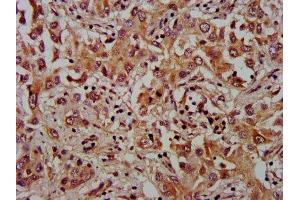 IHC image of ABIN7175929 diluted at 1:1000 and staining in paraffin-embedded human liver cancer performed on a Leica BondTM system. (XKR8 抗体  (AA 69-158))