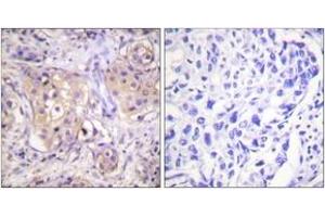 Immunohistochemistry analysis of paraffin-embedded human breast carcinoma, using PKC-pan (Phospho-Thr497) Antibody. (PKC 抗体  (pThr497))