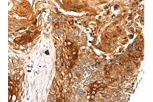 The image on the left is immunohistochemistry of paraffin-embedded Human esophagus cancer tissue using ABIN7192788(THAP9 Antibody) at dilution 1/20, on the right is treated with synthetic peptide. (THAP9 抗体)