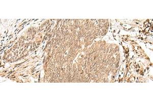 Immunohistochemistry of paraffin-embedded Human esophagus cancer tissue using VPS50 Polyclonal Antibody at dilution of 1:45(x200) (Syndetin/VPS50 抗体)