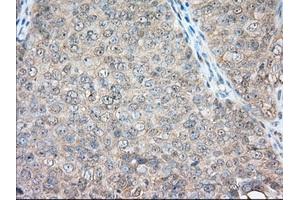Immunohistochemical staining of paraffin-embedded Adenocarcinoma of Human colon tissue using anti-BSG mouse monoclonal antibody. (CD147 抗体)