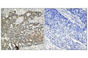Immunohistochemical analysis of paraffin-embedded human breast carcinoma tissue using p56Dok-2(Phospho-Tyr299) Antibody(left) or the same antibody preincubated with blocking peptide(right). (DOK2 抗体  (pTyr299))