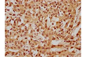 IHC image of nhibHU diluted at 1:8 and staining in paraffin-embedded human liver cancer performed on a Leica BondTM system. (HIST1H4A 抗体  (AA 1-12))