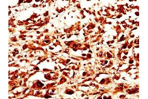 IHC image of ABIN7159229 diluted at 1:200 and staining in paraffin-embedded human melanoma performed on a Leica BondTM system. (Melanoma gp100 抗体  (AA 25-467))