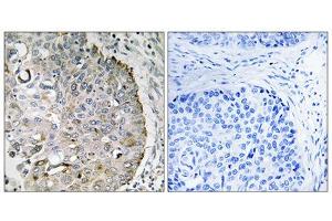 Immunohistochemistry analysis of paraffin-embedded human lung carcinoma tissue, using MRRF antibody. (MRRF 抗体  (C-Term))