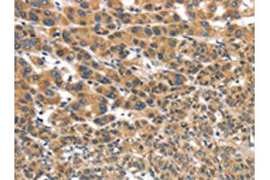 The image on the left is immunohistochemistry of paraffin-embedded Human liver cancer tissue using ABIN7192978(UBTD2 Antibody) at dilution 1/35, on the right is treated with synthetic peptide. (UBTD2 抗体)