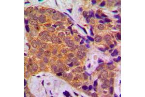 Immunohistochemical analysis of FOXO1 staining in human breast cancer formalin fixed paraffin embedded tissue section. (FOXO1 抗体  (Center))