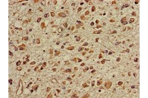 Immunohistochemistry of paraffin-embedded human glioma using ABIN7150673 at dilution of 1:100 (TGDS 抗体  (AA 143-305))