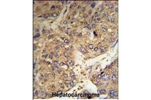 FGG Antibody (C-term) (R) IHC analysis in formalin fixed and paraffin embedded human hepatocarcinoma tissue followed by peroxidase conjugation of the secondary antibody and DAB staining. (FGG 抗体  (C-Term))