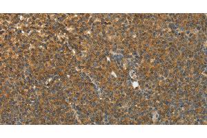 Immunohistochemistry of paraffin-embedded Human lymphoma using TEKT1 Polyclonal Antibody at dilution of 1:30 (TEKT1 抗体)