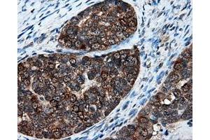 Immunohistochemical staining of paraffin-embedded Adenocarcinoma of breast tissue using anti-XRCC1 mouse monoclonal antibody. (XRCC1 抗体)