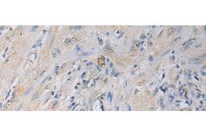Immunohistochemistry of paraffin-embedded Human gastric cancer tissue using HSDL2 Polyclonal Antibody at dilution of 1:55(x200) (HSDL2 抗体)