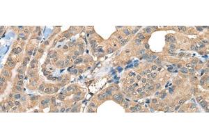 Immunohistochemistry of paraffin-embedded Human thyroid cancer tissue using CABP5 Polyclonal Antibody at dilution of 1:65(x200) (CABP5 抗体)