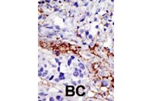 Formalin-fixed and paraffin-embedded human cancer tissue reacted with the primary antibody, which was peroxidase-conjugated to the secondary antibody, followed by DAB staining. (USP21 抗体  (C-Term))