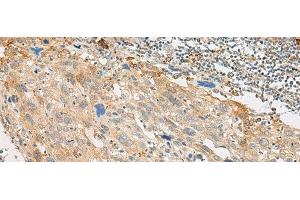Immunohistochemistry of paraffin-embedded Human cervical cancer tissue using GPR151 Polyclonal Antibody at dilution of 1:45(x200) (GPR151 抗体)