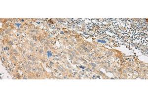 Immunohistochemistry of paraffin-embedded Human cervical cancer tissue using GPR151 Polyclonal Antibody at dilution of 1:45(x200) (GPR151 抗体)