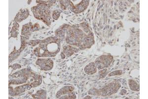 IHC-P Image Immunohistochemical analysis of paraffin-embedded N87 xenograft, using RAB2A, antibody at 1:100 dilution. (RAB2A 抗体  (C-Term))