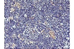 Immunohistochemical staining of paraffin-embedded Human lymphoma tissue using anti-DPP9 mouse monoclonal antibody. (DPP9 抗体)