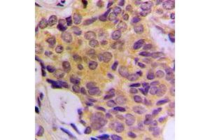 Immunohistochemical analysis of CDK5RAP3 staining in human breast cancer formalin fixed paraffin embedded tissue section. (CDK5RAP3 抗体  (Center))